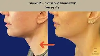 ניתוח מתיחת פנים וצוואר - לפני ואחרי - ד