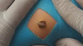 Treatment Of Blackhead Removal at Lam Dep Spa #036