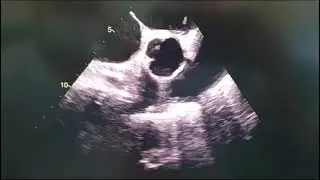 Rupture of Sinus Valsalva aneurysm with severe aortic regurgitation