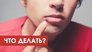НСП при герпесе, гайморит - Смирнова Нина