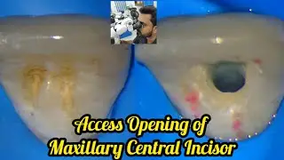 Access opening of Maxillary Central Incisor step by step demonstration# rct for beginners #rct