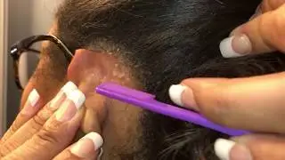 Husband films DANDRUFF SCRATCHING - HUGE SCALES behind my ears!