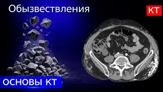 Лучевая диагностика | обызвествления на КТ : кальцинат, констриктивный перикардит, дерматополимиозит
