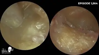 1,564 - Bilateral Rare Canal Cholesteotoma. Patient Waiting 2.5 Years to be seen by ENT