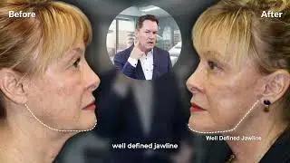 Face & Neck Lift - 69 Years Old