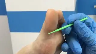 Удаление папилломы
