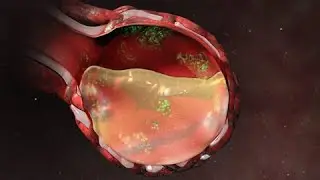 Pneumonia