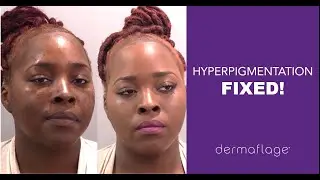 Hyperpigmentation- Customer Testimonial (a Concealer That Will Not Rub Off!)