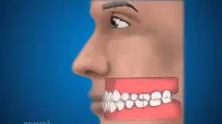 Ортопедическая стоматология  Типы физиологического прикуса