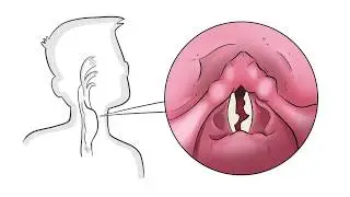 The 4 Underlying Causes of a Hoarse Voice