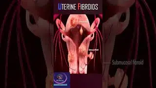 Uterine fibroids 3D animation 