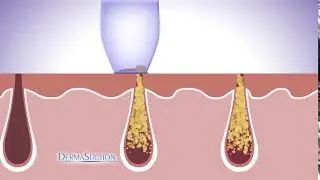 Derma Suction Device Electronic Blackhead Remover