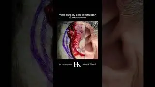 Scar Revision after Mohs Surgery on the ear using Interpolation closure | Dr. Hooman Khorasani | NYC