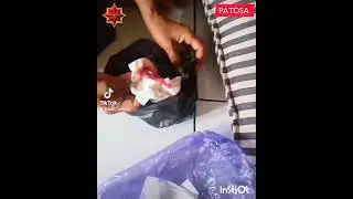 Penjelasan singkat tentang Bekam