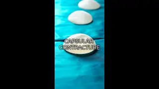 Capsular Contracture | How it Occurs & What Surgeons Do To Reduce It | Galanis Plastic Surgery