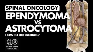 How to Differentiate Intramedullary Spinal Tumours? How to Interpret the MRI?