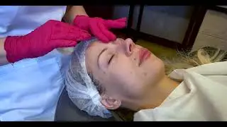Dermapen - jak wygląda zabieg odmładzający skórę? | BeautyNova Piaseczno