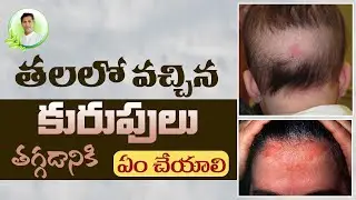 How to Treat Fungal Infections on Scalp and Beard | Health Tips In Telugu | Manthena Official