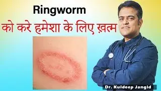 Ringworm Treatment (दाद) | Fungal Infection Infection Best Treatment | Best Homeopathic Doctor