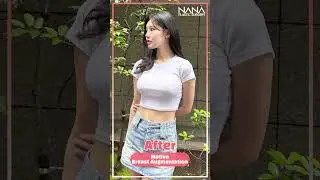 [SHORTS] Check out the differences before and after Motiva Breast Augmentation here at NANA!