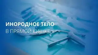 Извлечение инородных тел из прямой кишки
