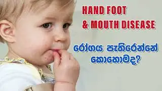 Hand Foot Mouth Disease -  දරුවා ආසාදනයවීම වළක්වා ගන්නේ  කොහොමද