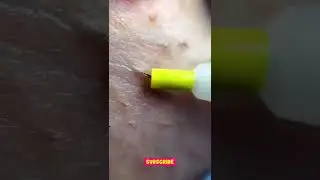 Ingrown Hair Super Zoom 