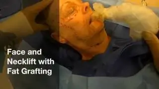 Facelift Surgery, Improve your Neck while Keeping a Natural Appearance!