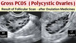 Polycystic Ovaries - Gross Grade 3 | PCOS | Ultrasound after Ovulation Medication