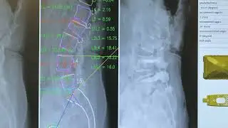 Measurement Technique for Lumbar Spine X-Ray Images