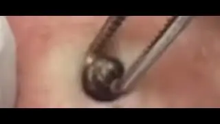 **Juicy Pimples** Pimple Popping Compilation (There is one clip you HAVE to SEE!!)
