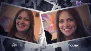 Отбеливание зубов  Zoom-4  в Ростове Центр Dental Spa