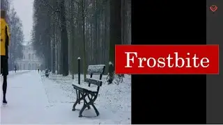 Frostbite |Homoeopathy and Health| Malayalam|