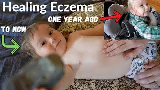 Aron Regimen 1 year later | Baby Eczema | Children with Eczema | Atopic Eczema | Dr. Sheila Kilbane