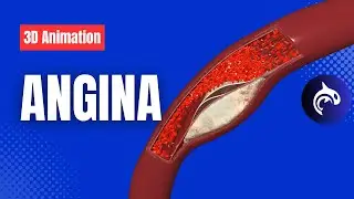 Angina (3D Animation) - Understand Chest Pain from Reduced Blood Flow to the Heart