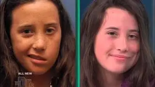 Gracie's New Smile | Facial Paralysis Surgery Results | Dr. Babak Azizzadeh (3 of 3)