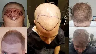HAIR TRANSPLANT TURKEY PRICE