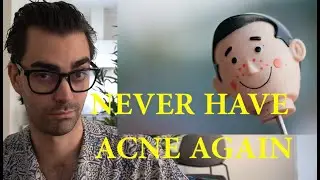How To Get Rid Of Acne And Pimples | Pharmacist Top Tips | Get Rid Of Acne Forever