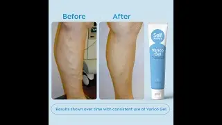 वैरिकोज वेन्स (Varicose Veins) का सबसे बेहतरीन उपाय | Varico Gel | वैरिको जेल | Self Matters