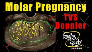 Molar Pregnancy || Hydatidiform Mole || TVS || Doppler || Ultrasound || Case 265