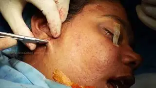 Facelift Plastic Surgery, Cosmetic Rhinoplasty | Dr. Sunil Richardson