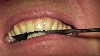 Reciprocated guide planes retained PEEK interim prosthesis
