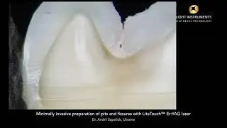 Minimally invasive preparation of pits and fissures with LiteTouch™ Er:YAG laser