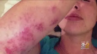 New Drug Approved For Kids With Eczema