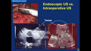 Intraoperative Ultrasound in Laparoscopic Pancreatic Surgery for Neuroendocrine Tumors