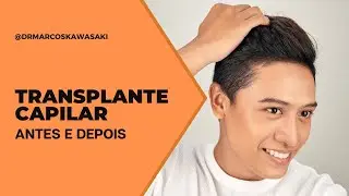 TRANSPLANTE CAPILAR | ANTES E DEPOIS