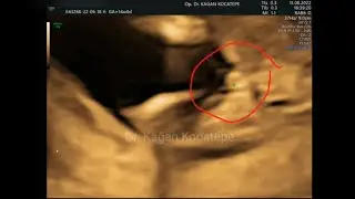 14 haftalık kız bebek, doğru tanı için bacak arasında labium majuslar ve klitoris mutlaka görülmeli.