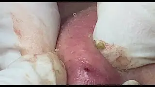 Hidden acne, hematoma ( P.2) #HoangMySpa119