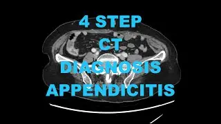 How to diagnose Acute Appendicitis on CT in 4 Steps - Radiology Medical Imaging Pearls, Tips, Tricks