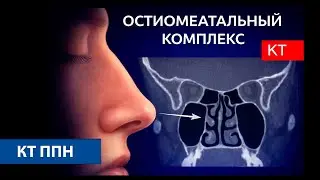 Лучевая анатомия остиомеатального комплекса и полости носа